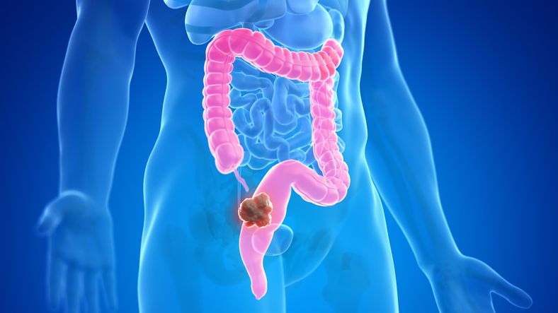Recreación de cáncer colorrectal