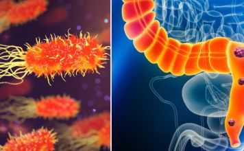 Esta bacteria podría aumentar el cáncer de colon en niños menores de 50 años. Esta bacteria podría aumentar el cáncer de colon en niños menores de 50 años.