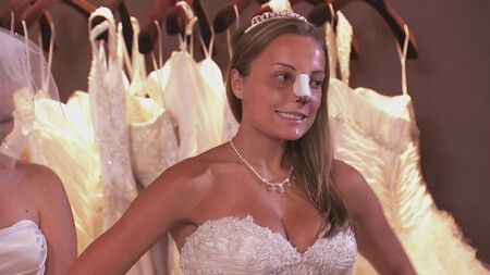 Bridalplastia