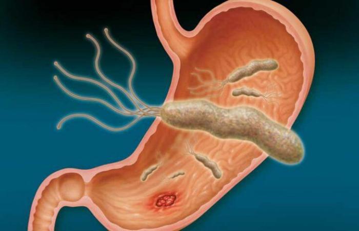 Alerta por la alta tasa de infección de un tipo de bacterias gástricas en Chile -.