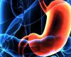 Un tumor asintomático relacionado con el Pylori Helicobácter -.