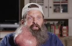 Hombre desarrolla tumor del tamaño de una sandía en el cuello